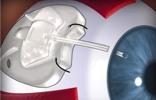 PHẪU THUẬT ĐẶT VAN AHMED - VÁ PHỦ CỦNG MẠC Ở BỆNH NHÂN GLAUCOMA